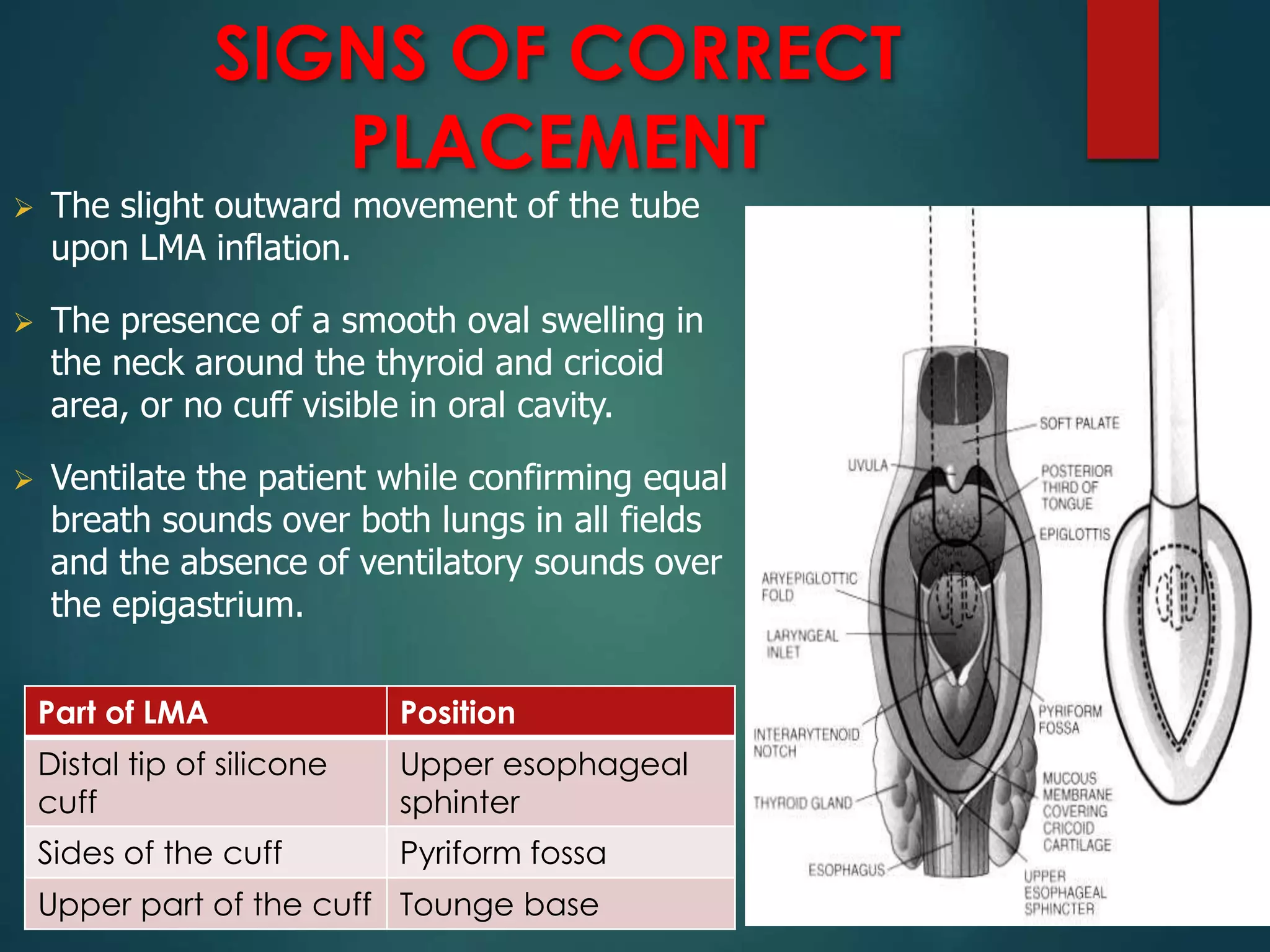 SIGNS OF CORRECT
PLACEMENT
 The slight outward movement of the tube
upon LMA inflation.
 The presence of a smooth oval swelling in
the neck around the thyroid and cricoid
area, or no cuff visible in oral cavity.
 Ventilate the patient while confirming equal
breath sounds over both lungs in all fields
and the absence of ventilatory sounds over
the epigastrium.
Part of LMA Position
Distal tip of silicone
cuff
Upper esophageal
sphinter
Sides of the cuff Pyriform fossa
Upper part of the cuff Tounge base
 