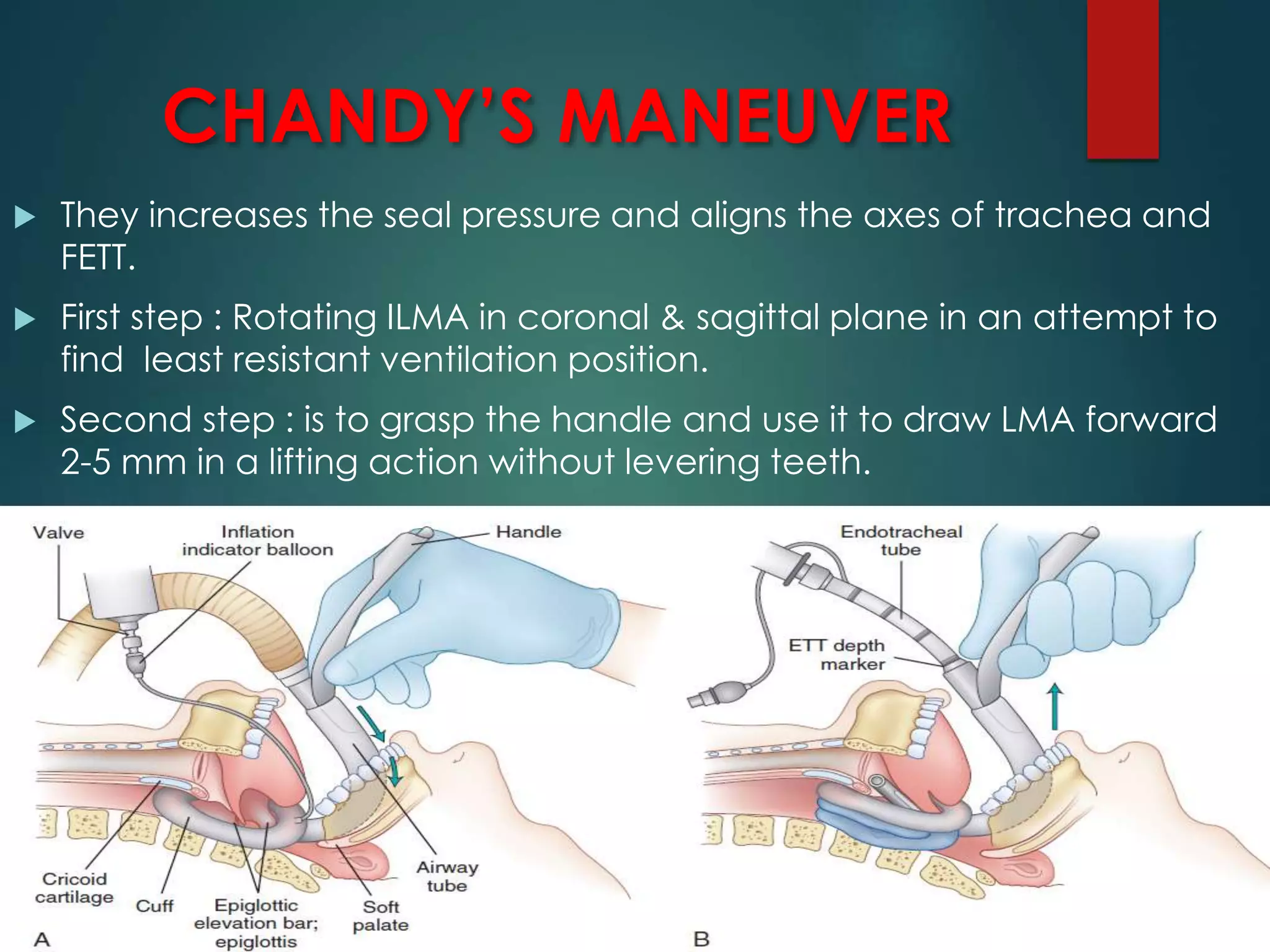CHANDY’S MANEUVER
 They increases the seal pressure and aligns the axes of trachea and
FETT.
 First step : Rotating ILMA in coronal & sagittal plane in an attempt to
find least resistant ventilation position.
 Second step : is to grasp the handle and use it to draw LMA forward
2-5 mm in a lifting action without levering teeth.
 