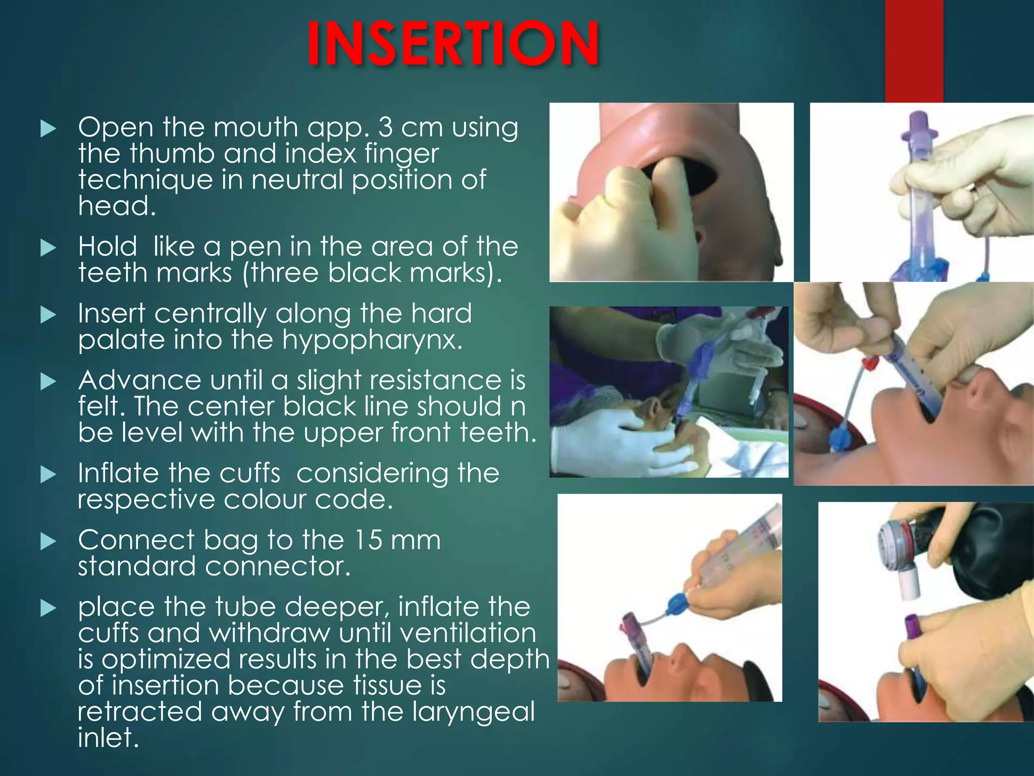 INSERTION
 Open the mouth app. 3 cm using
the thumb and index finger
technique in neutral position of
head.
 Hold like a pen in the area of the
teeth marks (three black marks).
 Insert centrally along the hard
palate into the hypopharynx.
 Advance until a slight resistance is
felt. The center black line should n
be level with the upper front teeth.
 Inflate the cuffs considering the
respective colour code.
 Connect bag to the 15 mm
standard connector.
 place the tube deeper, inflate the
cuffs and withdraw until ventilation
is optimized results in the best depth
of insertion because tissue is
retracted away from the laryngeal
inlet.
 