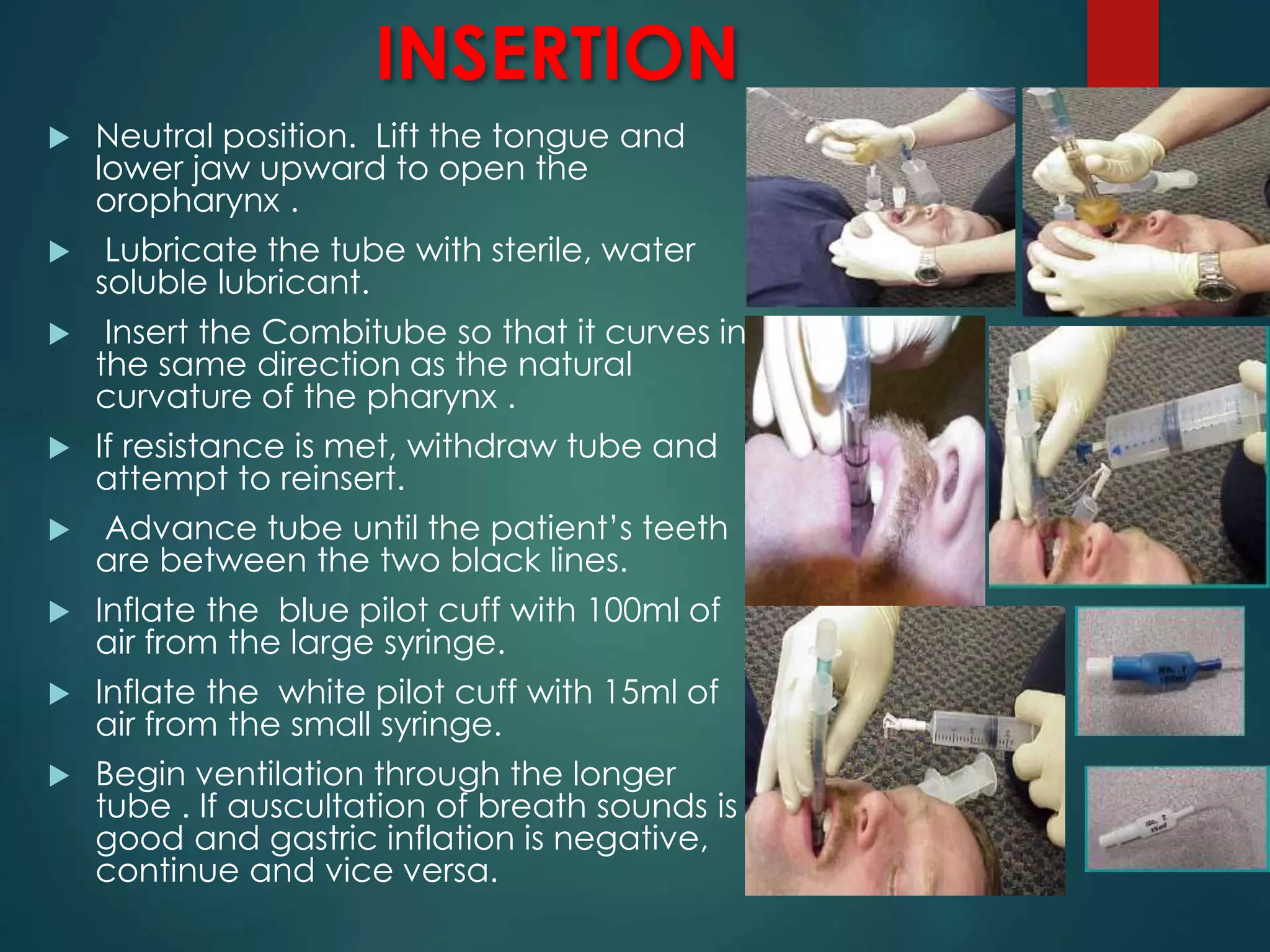 INSERTION
 Neutral position. Lift the tongue and
lower jaw upward to open the
oropharynx .
 Lubricate the tube with sterile, water
soluble lubricant.
 Insert the Combitube so that it curves in
the same direction as the natural
curvature of the pharynx .
 If resistance is met, withdraw tube and
attempt to reinsert.
 Advance tube until the patient’s teeth
are between the two black lines.
 Inflate the blue pilot cuff with 100ml of
air from the large syringe.
 Inflate the white pilot cuff with 15ml of
air from the small syringe.
 Begin ventilation through the longer
tube . If auscultation of breath sounds is
good and gastric inflation is negative,
continue and vice versa.
 