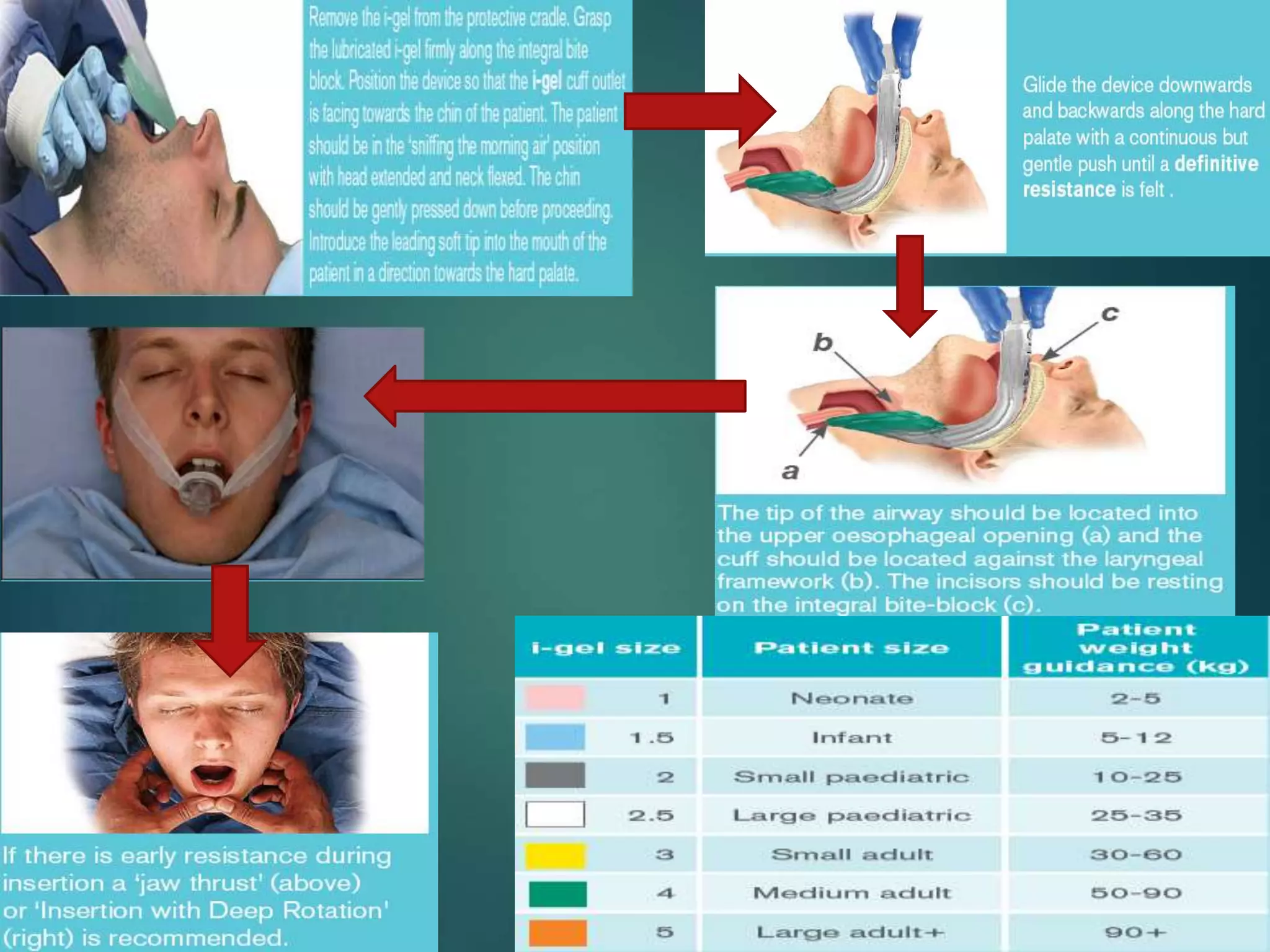 supraglottic-airway-device-pptx