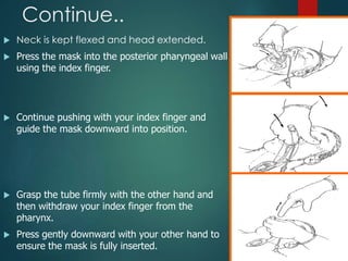 Continue..
 Neck is kept flexed and head extended.
 Press the mask into the posterior pharyngeal wall
using the index finger.
 Continue pushing with your index finger and
guide the mask downward into position.
 Grasp the tube firmly with the other hand and
then withdraw your index finger from the
pharynx.
 Press gently downward with your other hand to
ensure the mask is fully inserted.
 
