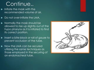 Continue..
 Inflate the mask with the
recommended volume of air.
 Do not over-inflate the LMA.
 Normally the mask should be
allowed to rise up slightly out of the
hypo pharynx as it is inflated to find
its correct position.
 Insert a bite-block or roll of gauze to
prevent occlusion of the tube.
 Now the LMA can be secured
utilizing the same techniques as
those employed in the securing of
an endotracheal tube.
 