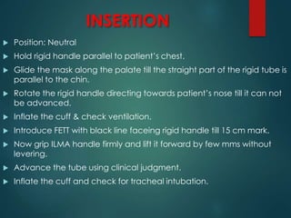 INSERTION
 Position: Neutral
 Hold rigid handle parallel to patient’s chest.
 Glide the mask along the palate till the straight part of the rigid tube is
parallel to the chin.
 Rotate the rigid handle directing towards patient’s nose till it can not
be advanced.
 Inflate the cuff & check ventilation.
 Introduce FETT with black line faceing rigid handle till 15 cm mark.
 Now grip ILMA handle firmly and lift it forward by few mms without
levering.
 Advance the tube using clinical judgment.
 Inflate the cuff and check for tracheal intubation.
 