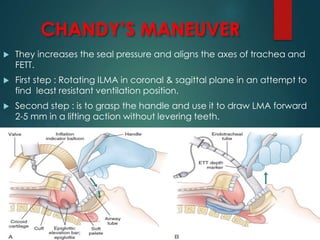 CHANDY’S MANEUVER
 They increases the seal pressure and aligns the axes of trachea and
FETT.
 First step : Rotating ILMA in coronal & sagittal plane in an attempt to
find least resistant ventilation position.
 Second step : is to grasp the handle and use it to draw LMA forward
2-5 mm in a lifting action without levering teeth.
 