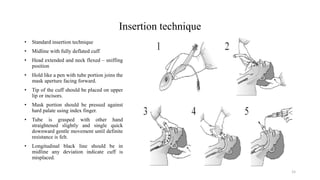 Insertion technique
• Standard insertion technique
• Midline with fully deflated cuff
• Head extended and neck flexed – sniffing
position
• Hold like a pen with tube portion joins the
mask aperture facing forward.
• Tip of the cuff should be placed on upper
lip or incisors.
• Mask portion should be pressed against
hard palate using index finger.
• Tube is grasped with other hand
straightened slightly and single quick
downward gentle movement until definite
resistance is felt.
• Longitudinal black line should be in
midline any deviation indicate cuff is
misplaced.
15
 