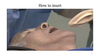How to insert
18
 