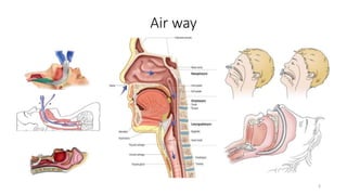 Air way
3
 