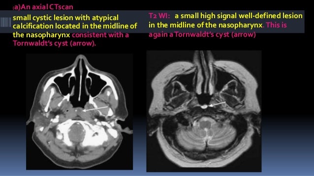 Suprahyoid cysts on CT & MRI