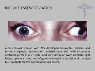 Supranuclearcontrolofgaze 180318184028 | PDF