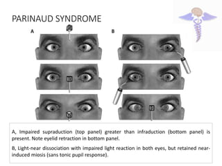 Infraduction Supranuclear control of gaze | PPTX