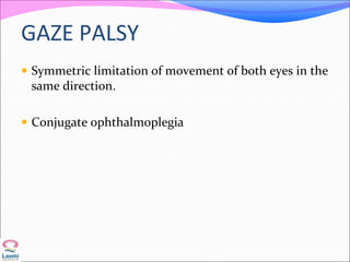 GAZE PALSY
 Symmetric limitation of movement of both eyes in the
same direction.
 Conjugate ophthalmoplegia
 