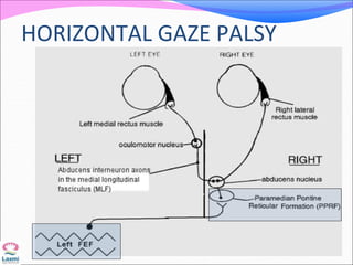 HORIZONTAL GAZE PALSY
 