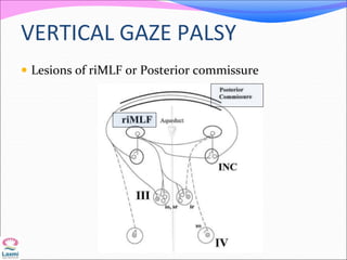 VERTICAL GAZE PALSY
 Lesions of riMLF or Posterior commissure
 