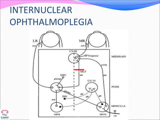 INTERNUCLEAR
OPHTHALMOPLEGIA
 