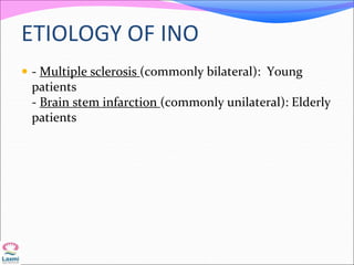 ETIOLOGY OF INO
 - Multiple sclerosis (commonly bilateral): Young
patients
- Brain stem infarction (commonly unilateral): Elderly
patients
 