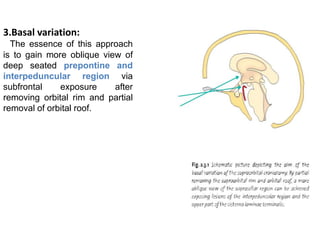 Supraorbital craniotomy. | PPTX