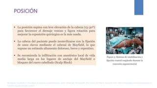 POSICIÓN
 La posición supina con leve elevación de la cabeza (15-30º)
para favorecer el drenaje venoso y ligera rotación para
mejorar la exposición quirúrgica es la más usada.
 La cabeza del paciente puede inomvilizarse con la fijación
de unos clavos mediante el cabezal de Mayfield, lo que
supone un estímulo altamente doloroso, breve y repentino.
 Se recomienda la infiltración con anestésico local de vida
media larga en los lugares de anclaje del Mayfield o
bloqueo del cuero cabelludo (Scalp Block)
Rodríguez Contreras R. Anestesia en tumores supratentoriales. parte I [Internet]. AnestesiaR. 2022 [cited 2023Apr2]. Available from: https://anestesiar.org/2022/anestesia-en-
tumores-supratentoriales-parte-i/
 