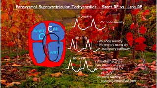 Supra ventri cular arrhythmia 2021 | PDF