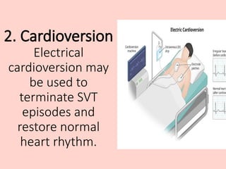 SUPRAVENTRICULAR TACCHYCARDIA WITH ITS TYPES AND MANAGEMENT | PPTX