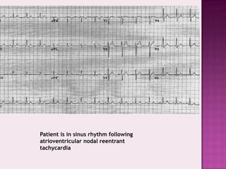 Patient is in sinus rhythm following
atrioventricular nodal reentrant
tachycardia

 