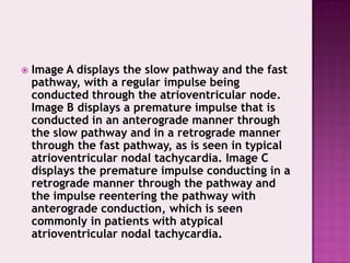 

Image A displays the slow pathway and the fast
pathway, with a regular impulse being
conducted through the atrioventricular node.
Image B displays a premature impulse that is
conducted in an anterograde manner through
the slow pathway and in a retrograde manner
through the fast pathway, as is seen in typical
atrioventricular nodal tachycardia. Image C
displays the premature impulse conducting in a
retrograde manner through the pathway and
the impulse reentering the pathway with
anterograde conduction, which is seen
commonly in patients with atypical
atrioventricular nodal tachycardia.

 