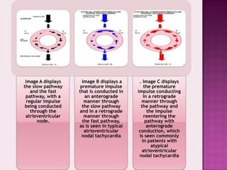 Image A displays
the slow pathway
and the fast
pathway, with a
regular impulse
being conducted
through the
atrioventricular
node.

Image B displays a
premature impulse
that is conducted in
an anterograde
manner through
the slow pathway
and in a retrograde
manner through
the fast pathway,
as is seen in typical
atrioventricular
nodal tachycardia

. Image C displays
the premature
impulse conducting
in a retrograde
manner through
the pathway and
the impulse
reentering the
pathway with
anterograde
conduction, which
is seen commonly
in patients with
atypical
atrioventricular
nodal tachycardia

 