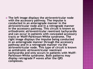 

The left image displays the atrioventricular node
with the accessory pathway. The impulse is
conducted in an anterograde manner in the
atrioventricular node and in a retrograde manner
in the accessory pathway. This circuit is known as
orthodromic atrioventricular reentrant tachycardia
and can occur in patients with concealed accessory
tracts or Wolff-Parkinson-White syndrome. The
right image displays the impulse being conducted
in an anterograde manner through the accessory
pathway and in a retrograde manner via the
atrioventricular node. This type of circuit is known
as antidromic atrioventricular reentrant
tachycardia and only occurs in patients with WolffParkinson-White syndrome. Both patterns may
display retrograde P waves after the QRS
complexes.

 
