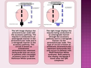 The left image displays the
atrioventricular node with
the accessory pathway. The
impulse is conducted in an
anterograde manner in the
atrioventricular node and in
a retrograde manner in the
accessory pathway. This
circuit is known as
orthodromic
atrioventricular reentrant
tachycardia and can occur
in patients with concealed
accessory tracts or WolffParkinson-White syndrome.

The right image displays the
impulse being conducted in
an anterograde manner
through the accessory
pathway and in a retrograde
manner via the
atrioventricular node. This
type of circuit is known as
antidromic atrioventricular
reentrant tachycardia and
only occurs in patients with
Wolff-Parkinson-White
syndrome. Both patterns
may display retrograde P
waves after the QRS
complexes

 
