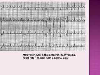 Atrioventricular nodal reentrant tachycardia.
heart rate 146 bpm with a normal axis.

 