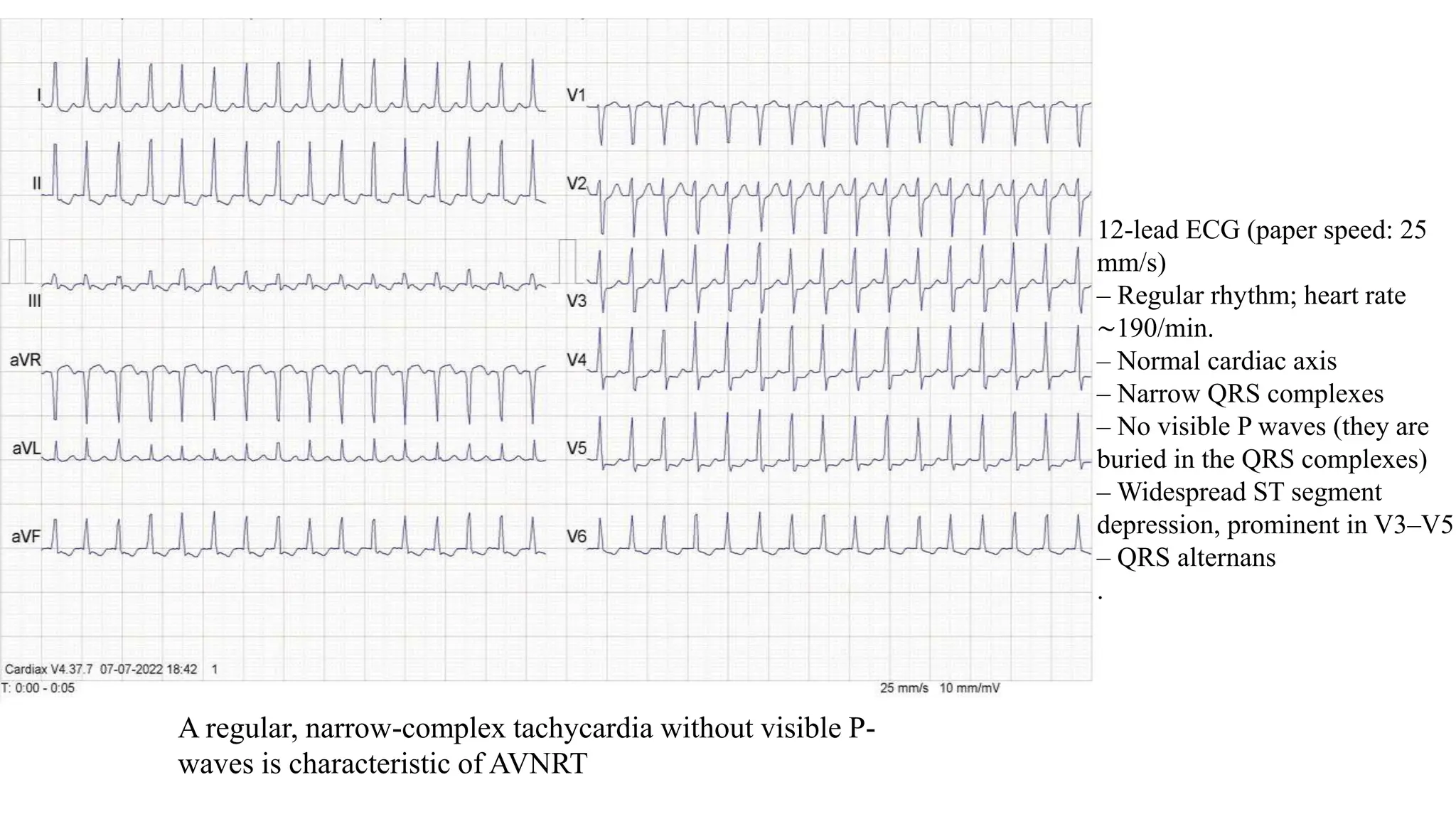 SupraventricularTachycardia.pptx