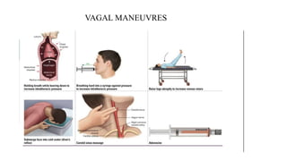 VAGAL MANEUVRES
 