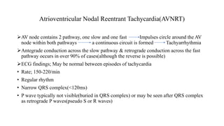 Atrioventricular Nodal Reentrant Tachycardia(AVNRT)
AV node contains 2 pathway, one slow and one fast Impulses circle around the AV
node within both pathways a continuous circuit is formed Tachyarrhythmia
Antegrade conduction across the slow pathway & retrograde conduction across the fast
pathway occurs in over 90% of cases(although the reverse is possible)
ECG findings; May be normal between episodes of tachycardia
• Rate; 150-220/min
• Regular rhythm
• Narrow QRS complex(<120ms)
• P wave typically not visible(buried in QRS complex) or may be seen after QRS complex
as retrograde P waves(pseudo S or R waves)
 