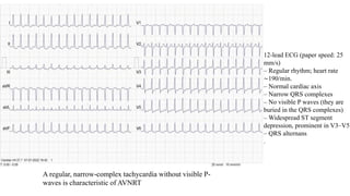 12-lead ECG (paper speed: 25
mm/s)
– Regular rhythm; heart rate
∼190/min.
– Normal cardiac axis
– Narrow QRS complexes
– No visible P waves (they are
buried in the QRS complexes)
– Widespread ST segment
depression, prominent in V3–V5
– QRS alternans
.
A regular, narrow-complex tachycardia without visible P-
waves is characteristic of AVNRT
 