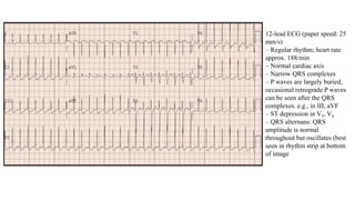 12-lead ECG (paper speed: 25
mm/s)
– Regular rhythm; heart rate
approx. 188/min
– Normal cardiac axis
– Narrow QRS complexes
– P waves are largely buried,
occasional retrograde P waves
can be seen after the QRS
complexes. e.g., in III, aVF
– ST depression in V5, V6
– QRS alternans: QRS
amplitude is normal
throughout but oscillates (best
seen in rhythm strip at bottom
of image
 
