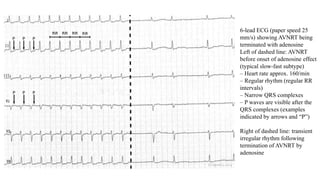 6-lead ECG (paper speed 25
mm/s) showing AVNRT being
terminated with adenosine
Left of dashed line: AVNRT
before onset of adenosine effect
(typical slow-fast subtype)
– Heart rate approx. 160/min
– Regular rhythm (regular RR
intervals)
– Narrow QRS complexes
– P waves are visible after the
QRS complexes (examples
indicated by arrows and “P”)
Right of dashed line: transient
irregular rhythm following
termination of AVNRT by
adenosine
 