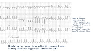 -Rate > 250bpm
-Regular rhythm
-Narrow QRS complex
-Retrograde P waves in
V1 (notch just
preceding T wave)with
long RP interval> 70ms
Regular, narrow complex tachycardia with retrograde P waves
and long RP interval suggestive of Orthodromic AVRT
 