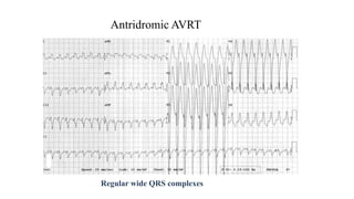 Antridromic AVRT
Regular wide QRS complexes
 