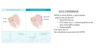 •While in sinus rhythm, a preexcitation
pattern may be present
• Short PR interval
• ECG delta wave: a slurred upstroke at the
start of the QRS complex
• Widened QRS
•Can show any of
the arrhythmias associated with WPW
ECG FINDINGS
 