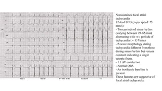 Nonsustained focal atrial
tachycardia
12-lead ECG (paper speed: 25
mm/s)
- Two periods of sinus rhythm
(varying between 79–85/min)
alternating with two periods of
tachycardia (∼ 137/min)
- P-wave morphology during
tachycardia different from those
during sinus rhythm but remain
constant indicating a single
ectopic focus.
- 1:1 AV conduction
- Normal QRS
- An isoelectric baseline is
present.
These features are suggestive of
focal atrial tachycardia.
 