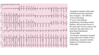 -Irregularly irregular tachycardia
with both atrial and ventricular
rates of approx. 120–200/min
-Left axis deviation
-P waves with different
morphologies (including normal,
biphasic, and inverted waves) in
the same lead. P waves return to the
isoelectric line (thus there is no
atrial flutter/fibrillation).
-Normal QRS
-In summary: Irregularly irregular
tachycardia with variable P-wave
morphology, consistent with the
diagnosis of multifocal atrial
tachycardia.
 