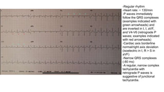 -Regular rhythm
-Heart rate: ~ 130/min
-P waves immediately
follow the QRS complexes
(examples indicated with
green arrowheads) and
are inverted in I, I, aVF,
and V4-V6 (retrograde P
waves; examples indicated
with red arrowheads)
-Cardiac axis borderline
normal/right axis deviation
(isoelectric in I, R > S in
aVF)
-Narrow QRS complexes
(-80 ms)
-A regular, narrow complex
tachycardia with
retrograde P waves is
suggestive of junctional
tachycardia.
 