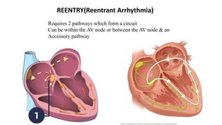 REENTRY(Reentrant Arrhythmia)
Requires 2 pathways which form a circuit
Can be within the AV node or between the AV node & an
Accessory pathway
 