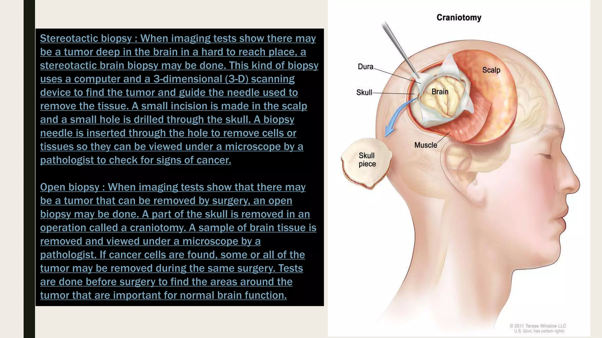 Supratentorial brain tumours | PPTX