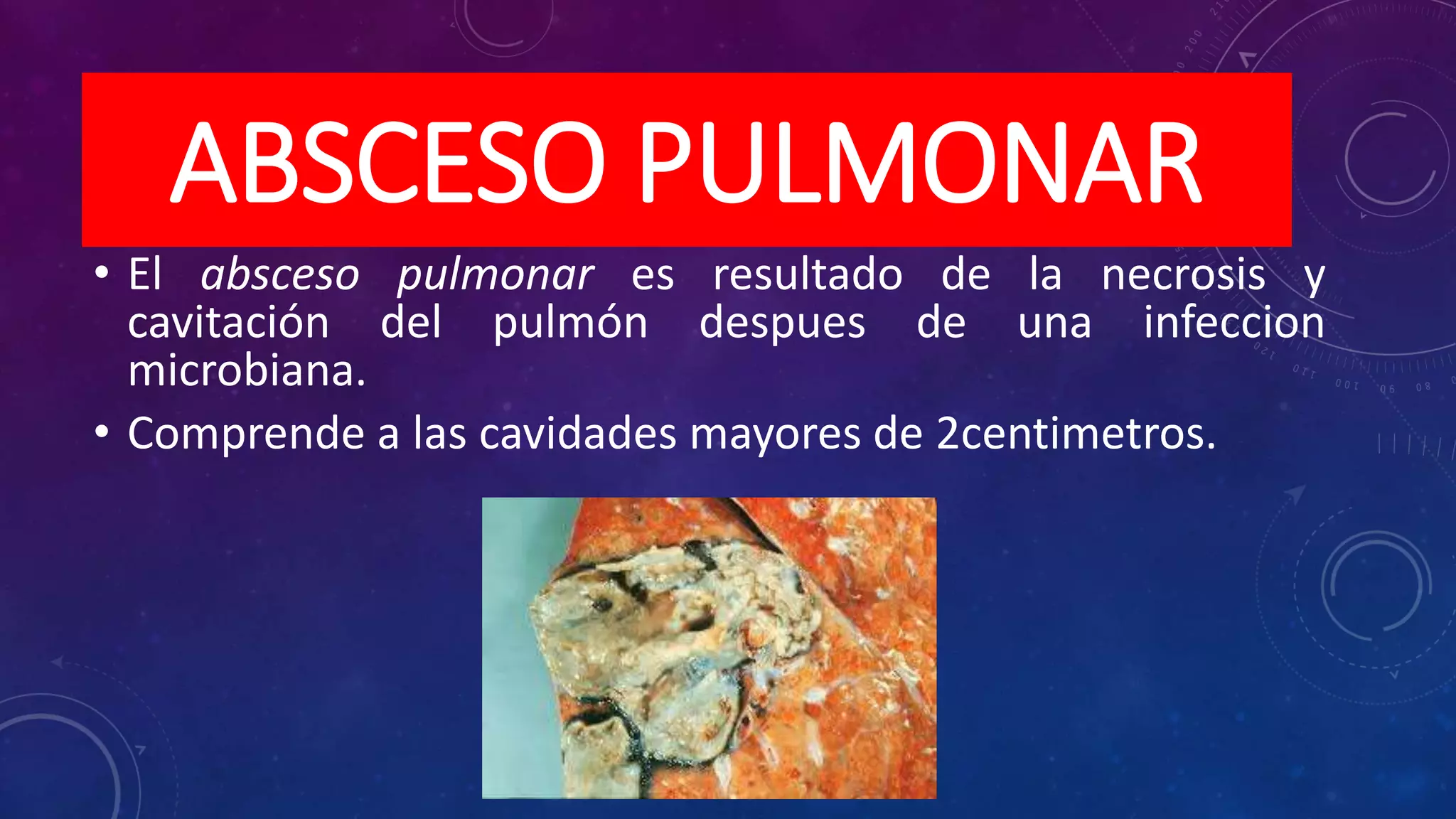 Supuraciones pleuropulmonares | PPT