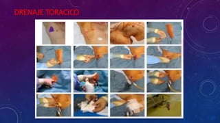 DRENAJE TORACICO
 