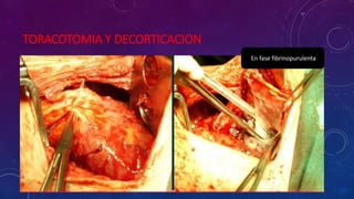 TORACOTOMIA Y DECORTICACION
En fase fibrinopurulenta
 