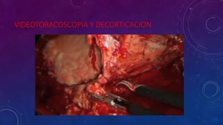 VIDEOTORACOSCOPIA Y DECORTICACION
 