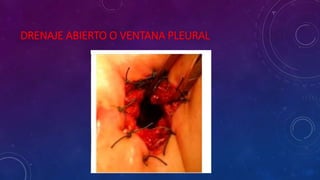 DRENAJE ABIERTO O VENTANA PLEURAL
 