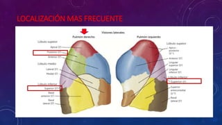 LOCALIZACIÓN MAS FRECUENTE
 